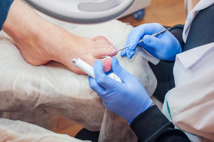 Behandlung von Nagelpilz beim Arzt