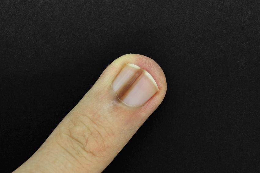 Nagelverfärbung eines Fingernagels - Nagelveränderungen